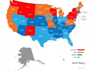 Gastric bypass prices by state.