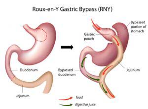 gastric bypass procedure