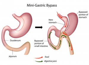 Mini gastric bypass procedure.