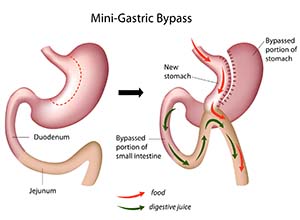 Mini-Gastric bypass surgery.