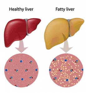 Normal liver compared to fatty liver.