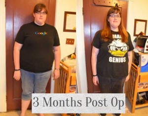 Fallon's before and after gastric bypass at 3 months.