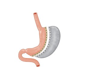 Stomach after sleeve gastrectomy surgery.