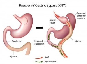 Gastric bypass procedure details.