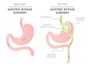 Gastric bypass pouch after surgery.