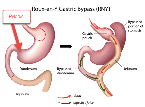 Gastric Bypass – Pylorus and Dumping Syndrome | Obesity Coverage