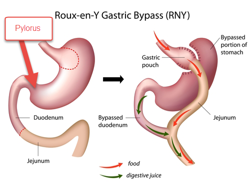 Gastric Bypass – Pylorus and Dumping Syndrome | Obesity Coverage Gastric Bypass – Pylorus and Dumping Syndrome | Obesity Coverage