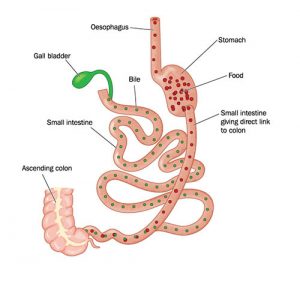 Diagram showing duodendal switch surgery.