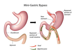 Mini gastric bypass procedure.