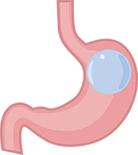 Gastric balloon inflated.