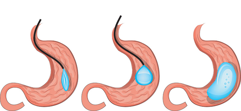 Gastric balloon insertion.