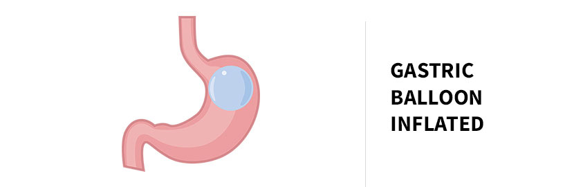 Gastric balloon inflated.