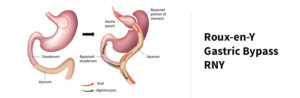 Gastric bypass procedure details.