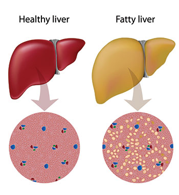 Fatty liver disease compared to healthy liver. 