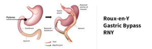 Bypassing the pylorus can cause dumping syndrome.