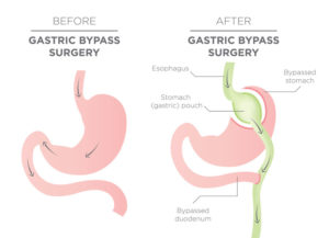 Gastric bypass diagram.