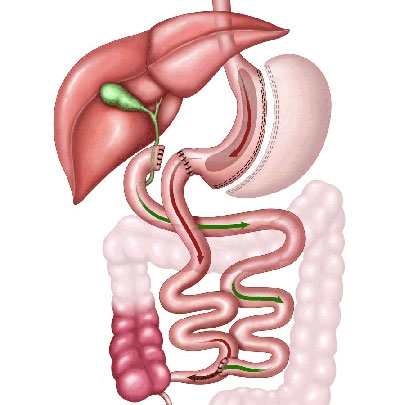 Duodenal switch diagram.