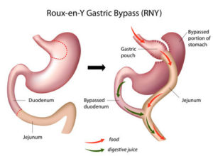 Gastric bypass procedure
