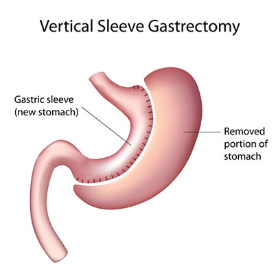 Gastric sleeve diagram.