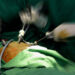 Gastric sleeve surgery being performed.